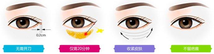 韩式去眼袋手术果怎样