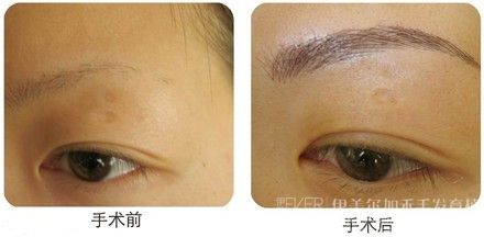 眉毛少怎么办 种植眉毛手术果图看看就明白