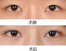 埋线双眼皮能保持多长时间