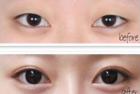 三点定位双眼皮手术果如何