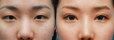 三点定位双眼皮失败可以修复吗
