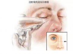 玻尿酸填充泪沟有哪些优势呢