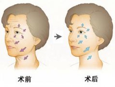 玻尿酸去皱有副作用吗 玻尿酸去皱有副作用吗