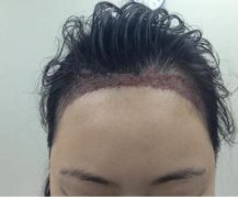 头发种植原理 头发种植前注意事项有哪些 头发种植原理 头发种植前注意事项有哪些