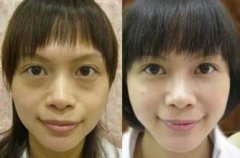 怎样预防和消除黑眼圈眼袋