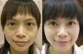 怎样预防和消除黑眼圈眼袋