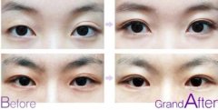 双眼皮修复手术适应症