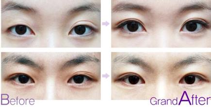 双眼皮修复手术适应症