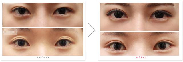修复失败双眼皮的方法