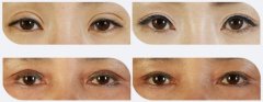 双眼皮失败修复对比图片
