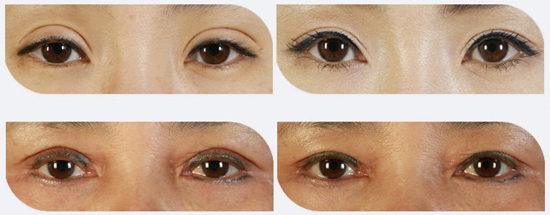 双眼皮失败修复对比图片