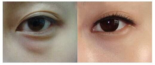 upl超脉冲激光祛眼袋手术方法