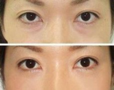 激光去除黑眼袋好不好