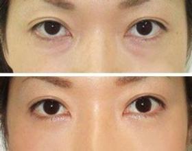 激光去除黑眼袋好不好