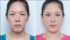 激光去眼袋果如何