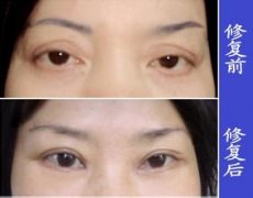割双眼皮失败手术修复方法