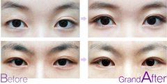 双眼皮修复手术果前后对比图片
