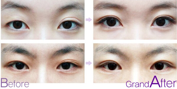 双眼皮修复手术果前后对比图片