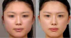 注射注射瘦脸瘦脸果怎么样