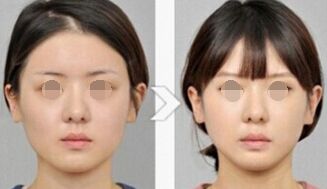 B****打几次能定型