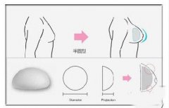 假体丰胸果好不降低风险不 假体丰胸果好不降低风险不