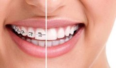 牙齿矫正有什么方法吗