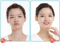 双眼皮打*药疼不疼