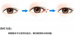 开眼角手术是怎么做的 开眼角手术后要多久恢复