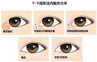 开眼角手术,后遗症,术前,注意事项