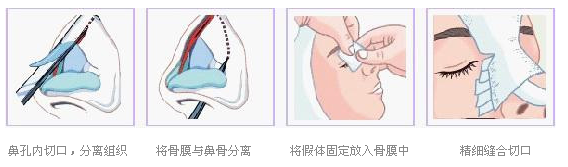 唐山美联臣假体隆鼻