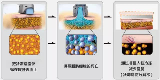 热立塑、超声减脂和冷冻溶脂减肥三者之间有什么区别