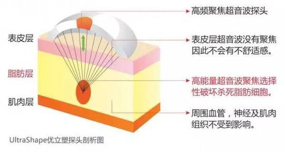 热立塑、超声减脂和冷冻溶脂减肥三者之间有什么区别