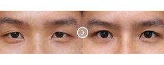 专业提眉整形手术帮您落实漂亮眉形