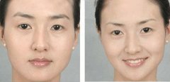 眉毛不好看怎么办 隐形提眉整形手术来帮您