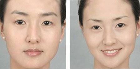 眉毛不好看怎么办 隐形提眉整形手术来帮您