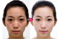 怎样可以快速有去除眼袋 眼袋手术真的能去除吗