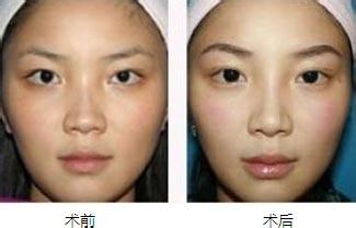 眉弓整形前后对比图