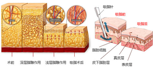 上海华美手臂吸脂果如何