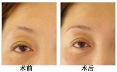 眉毛整形果图