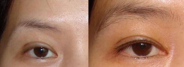 眉毛整形对比果照片图