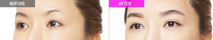 眉毛整形对比果照片图