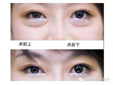 去眼袋整形手术方法有哪些