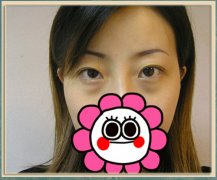 去眼袋整形对比图 去眼袋整形对比图