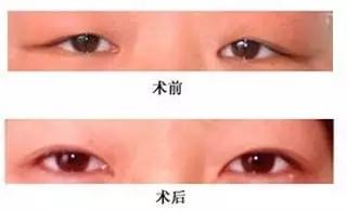 修复双眼皮失败有几种方法