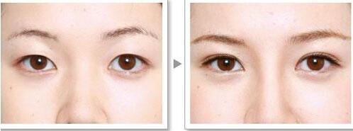 修复双眼皮失败有几种方法