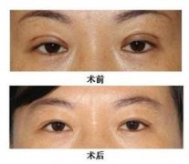 双眼皮失败后修复的方法有哪些