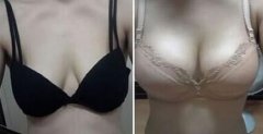 自体脂肪隆胸和假体隆胸的区别在哪儿