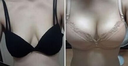 自体脂肪隆胸和假体隆胸的区别在哪儿