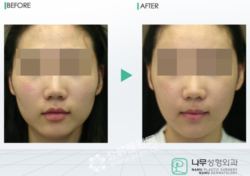 那些,关于,磨骨瘦脸,误区