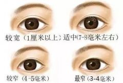 双眼皮手术后留疤怎么处理